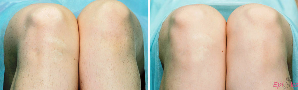 Результаты лазерного облучения после первой процедуры видны на фото до и после