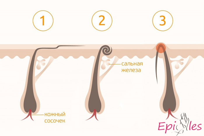вросшие волосы после шугаринга